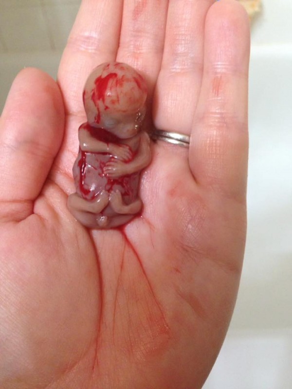 abgetriebenerFoetus